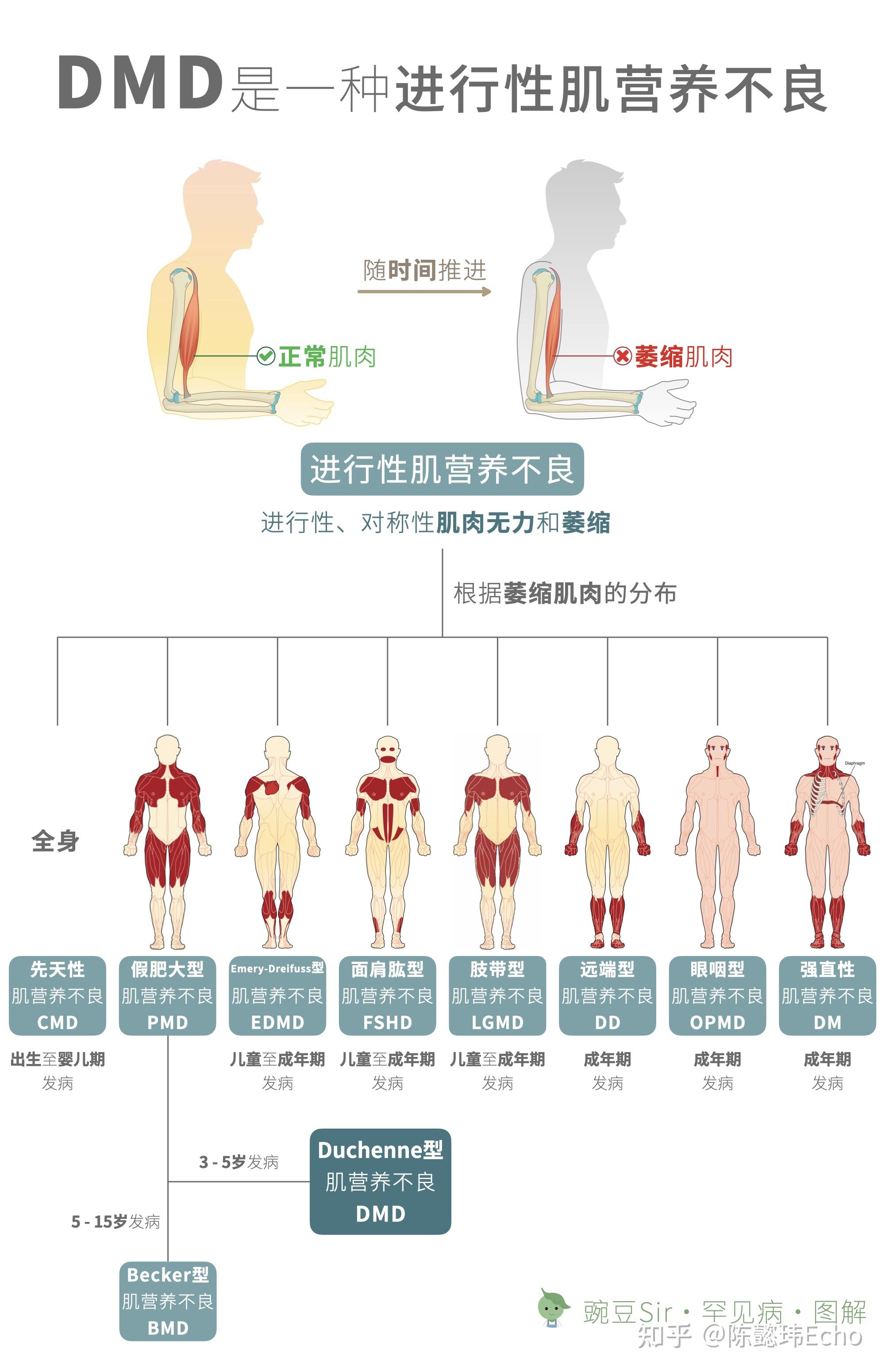 肌营养不良几岁发病图片