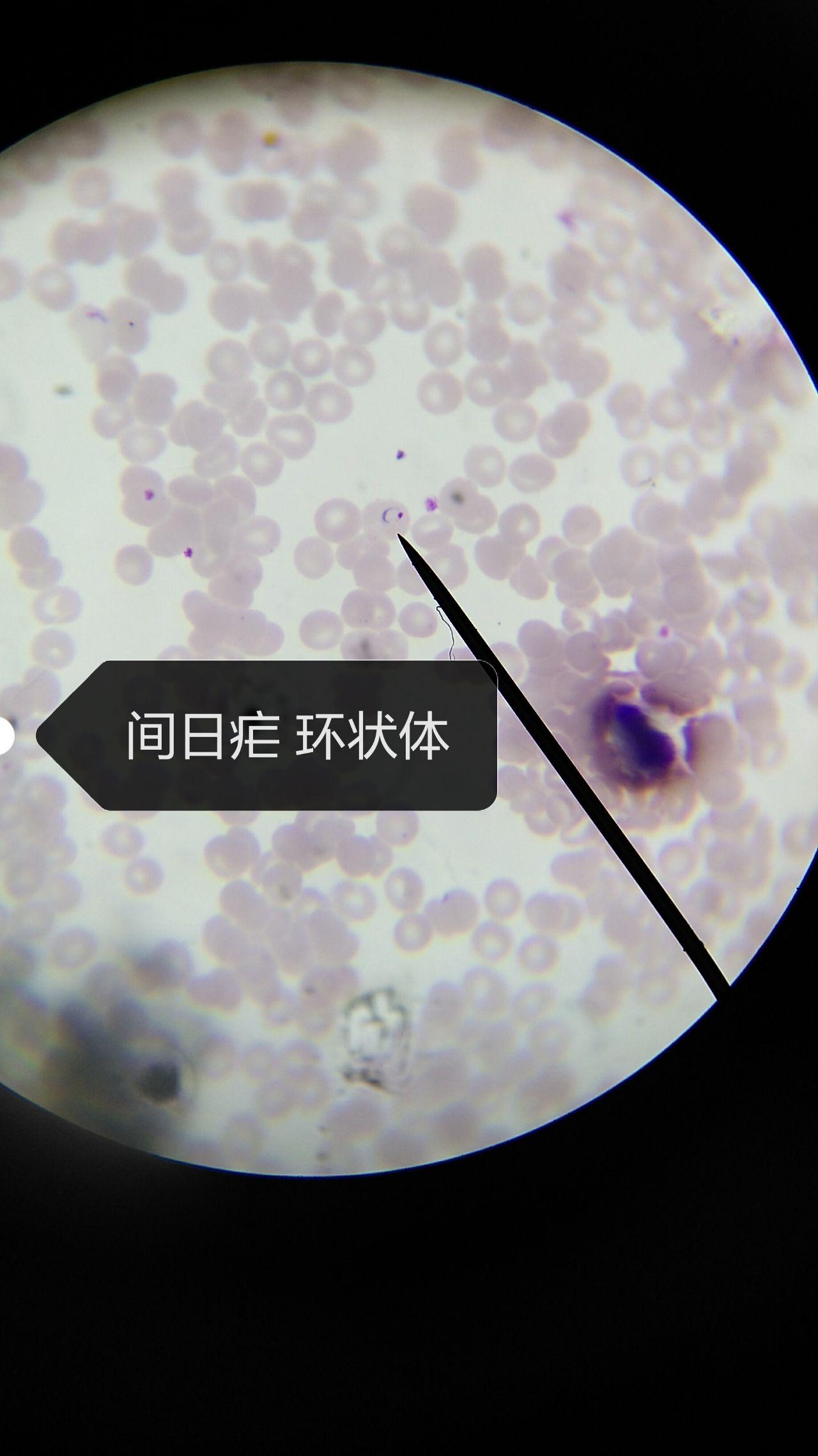 红血球中的疟原虫 库存图片. 图片 包括有 研究, 疾病, 科学, 污迹, 阶段, 环形, 测试, 检查 - 161613619