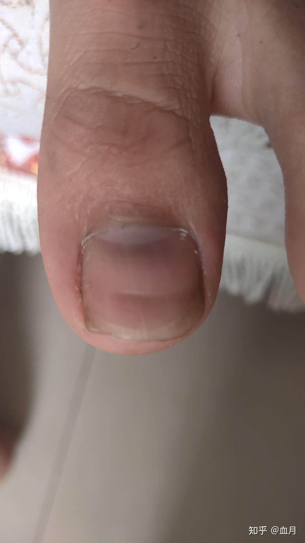 大脚趾甲有一条特别深的横纹,看起来跟裂开了一样,想请教一下这是怎么