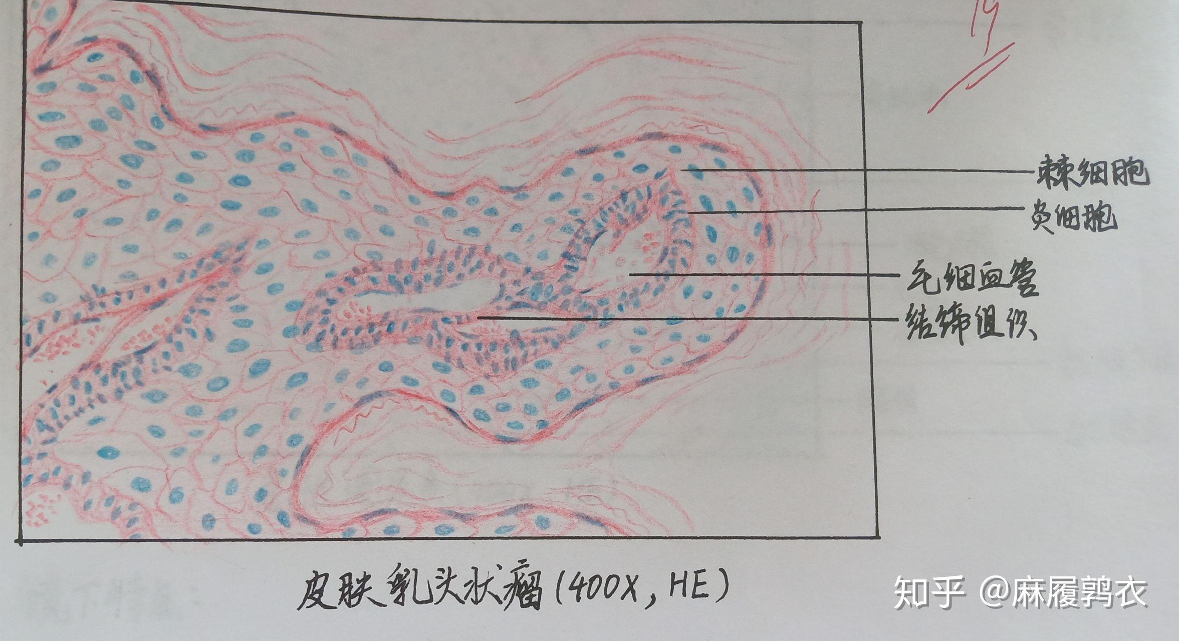 为什么咱们不弄个病理红蓝手绘图的问题呢? - 知乎