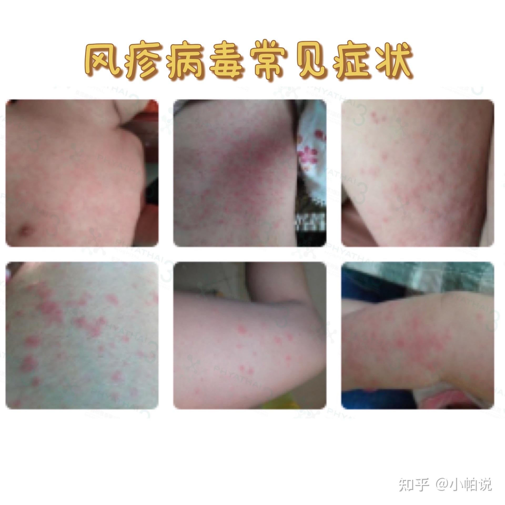 检查单纯疱疹病毒igg阳性,可以做试管吗? - 知乎