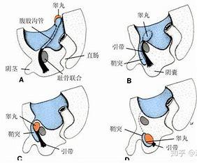 尿道下裂隐睾图片