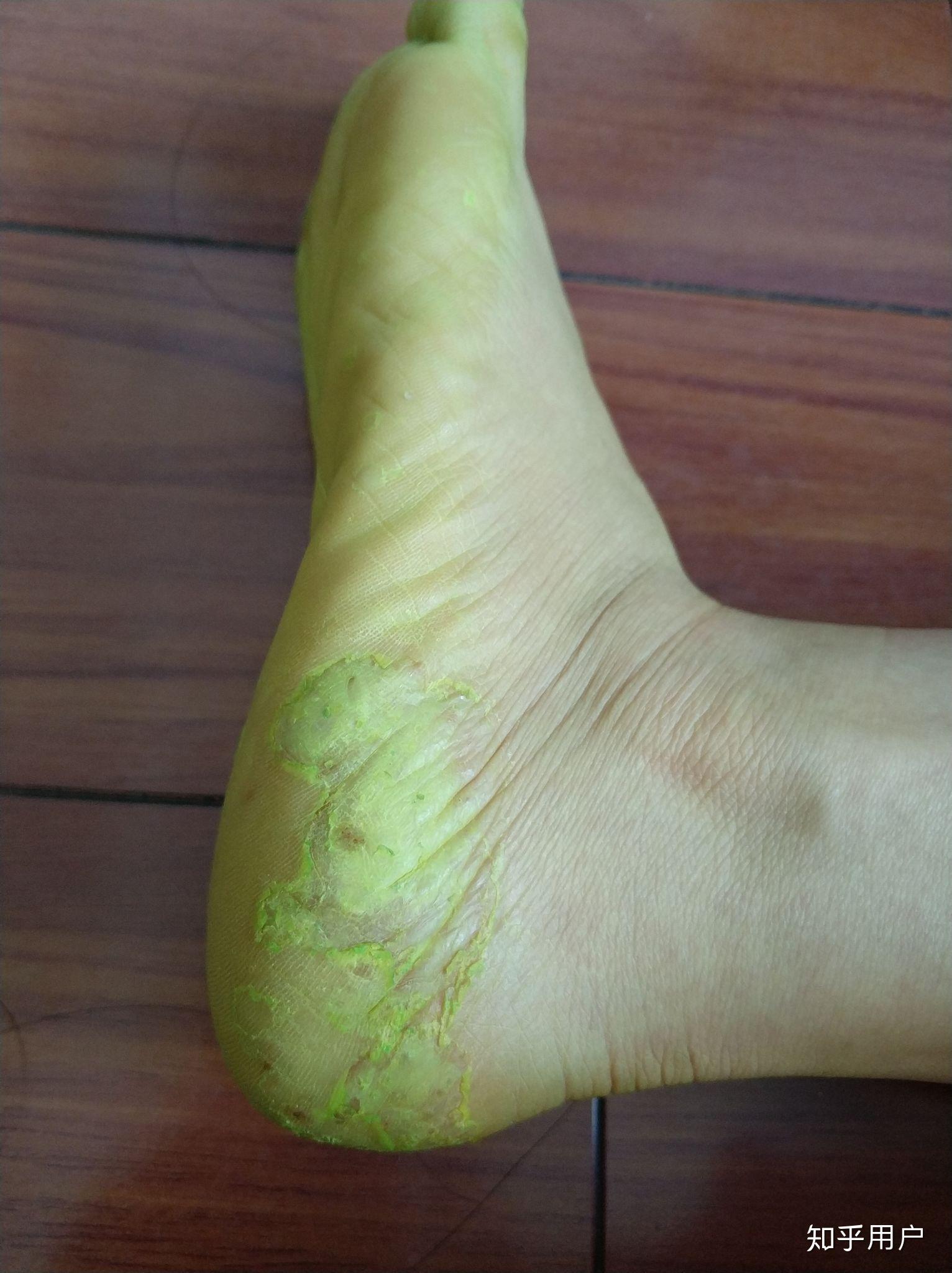 珊瑚癣净管用吗