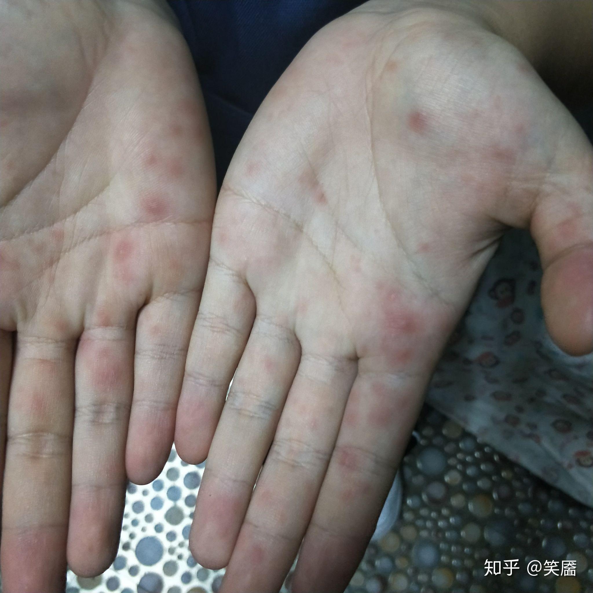 成年人被儿童传染了手足口是种什么体验
