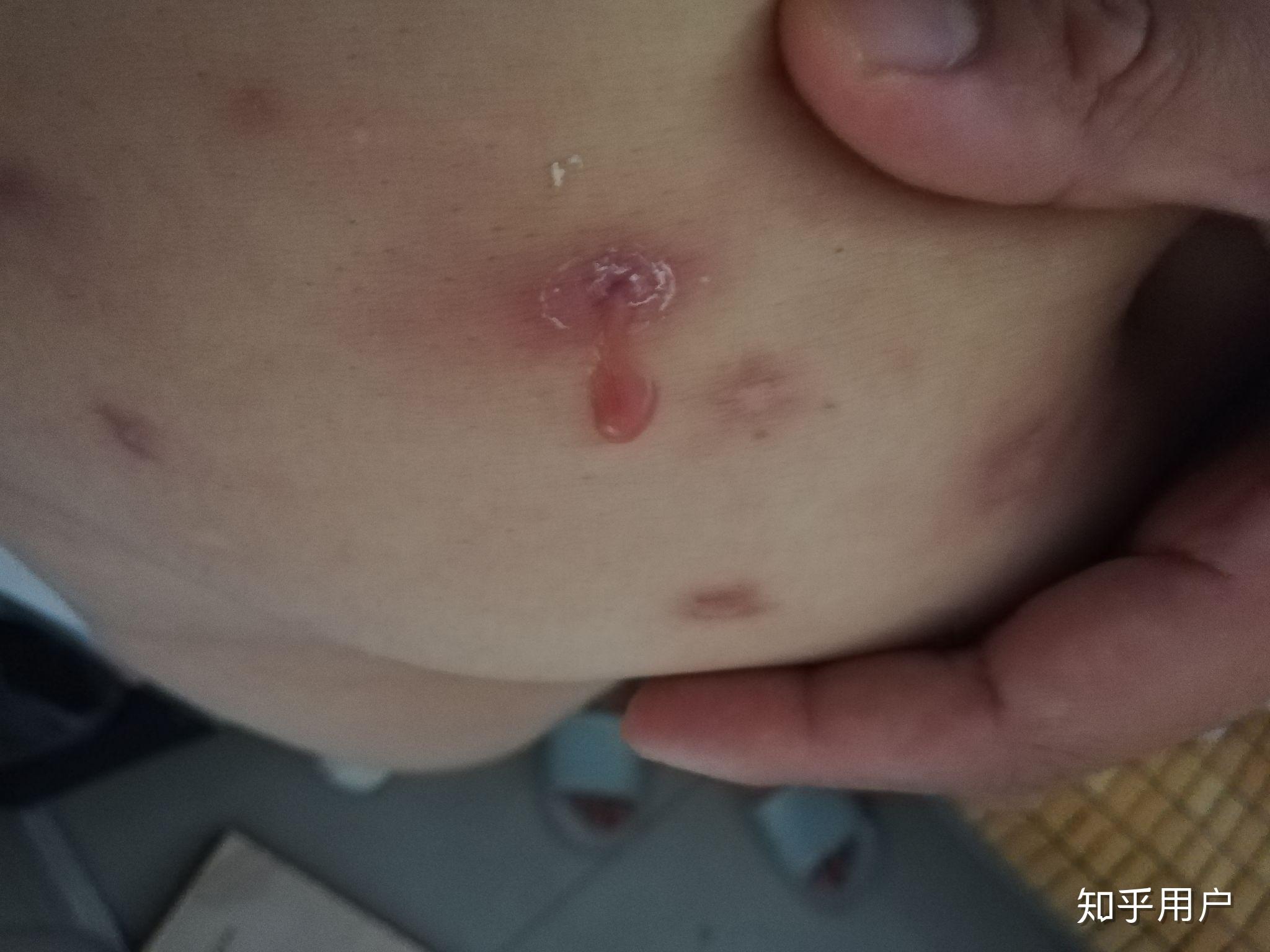 长火疖子怎么治很恐怖吗