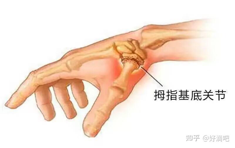 得了第一腕掌关节骨关节炎一定要手术治疗吗