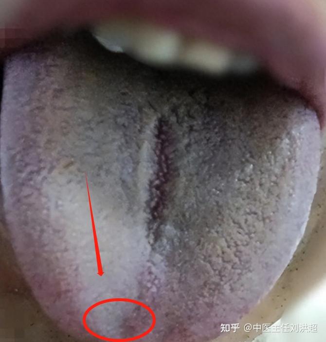 舌头凹陷是怎么回事? - 知乎