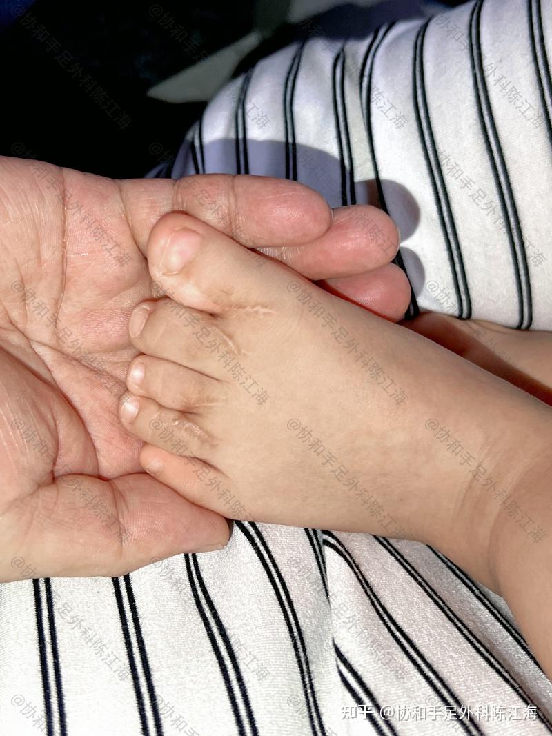 孩子9 月上幼儿园,脚趾两个指头并指,如何给孩子解释和教育,能让孩子