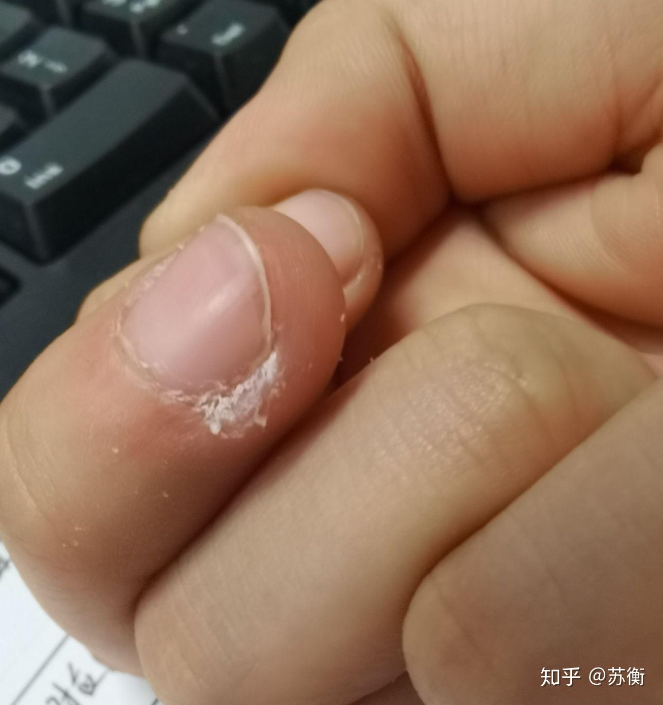 强迫性皮肤剥离症是什么? - 知乎