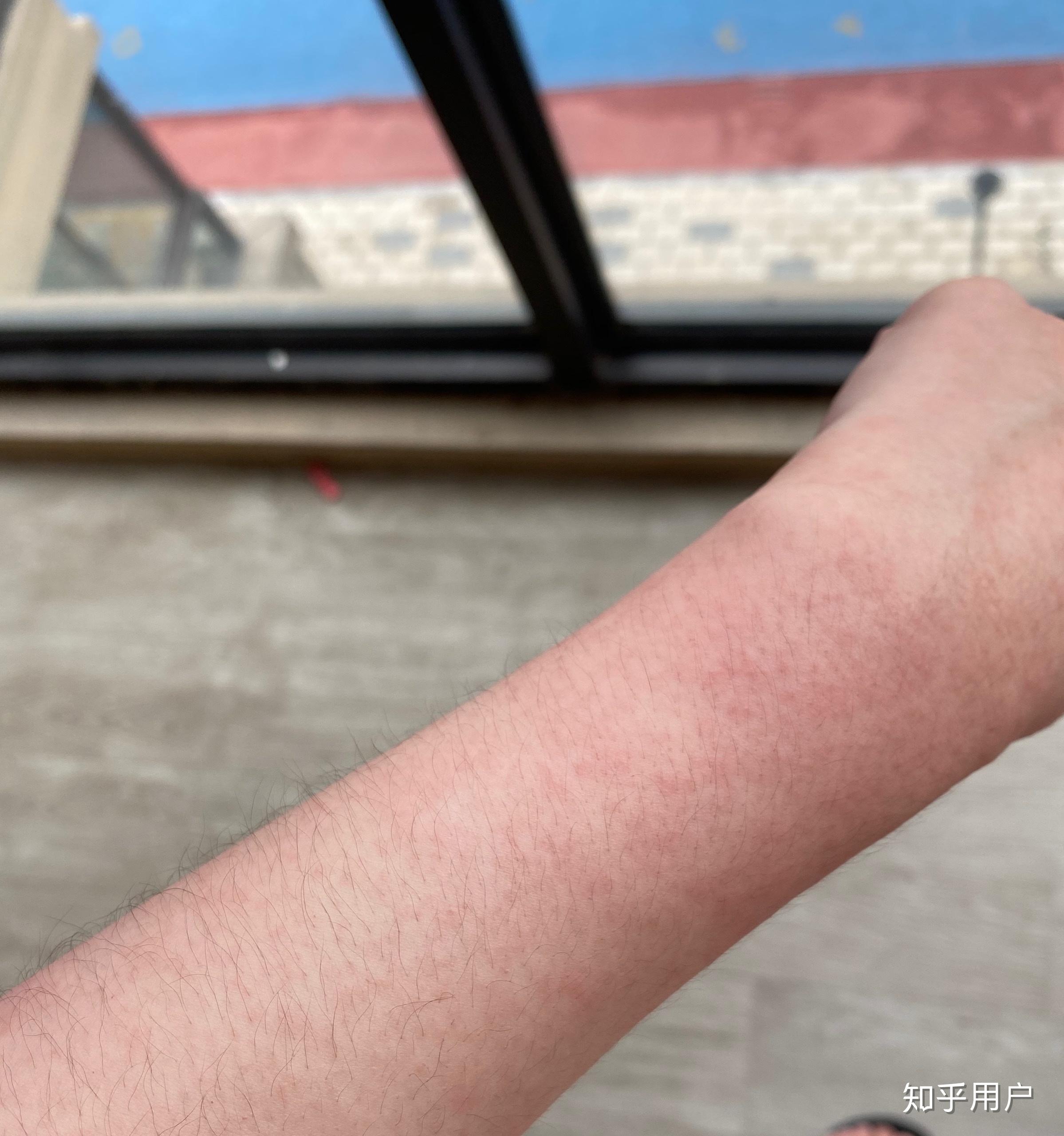 酒精过敏的人喝多了会怎么样? - 知乎