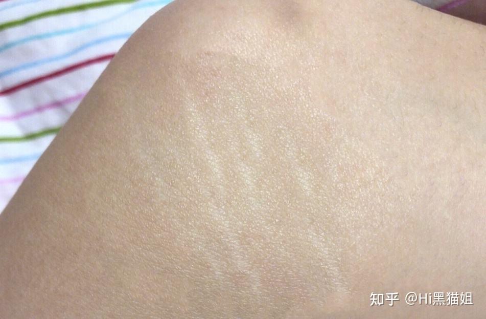腰腹吸脂会不会出现肥胖纹? - 知乎