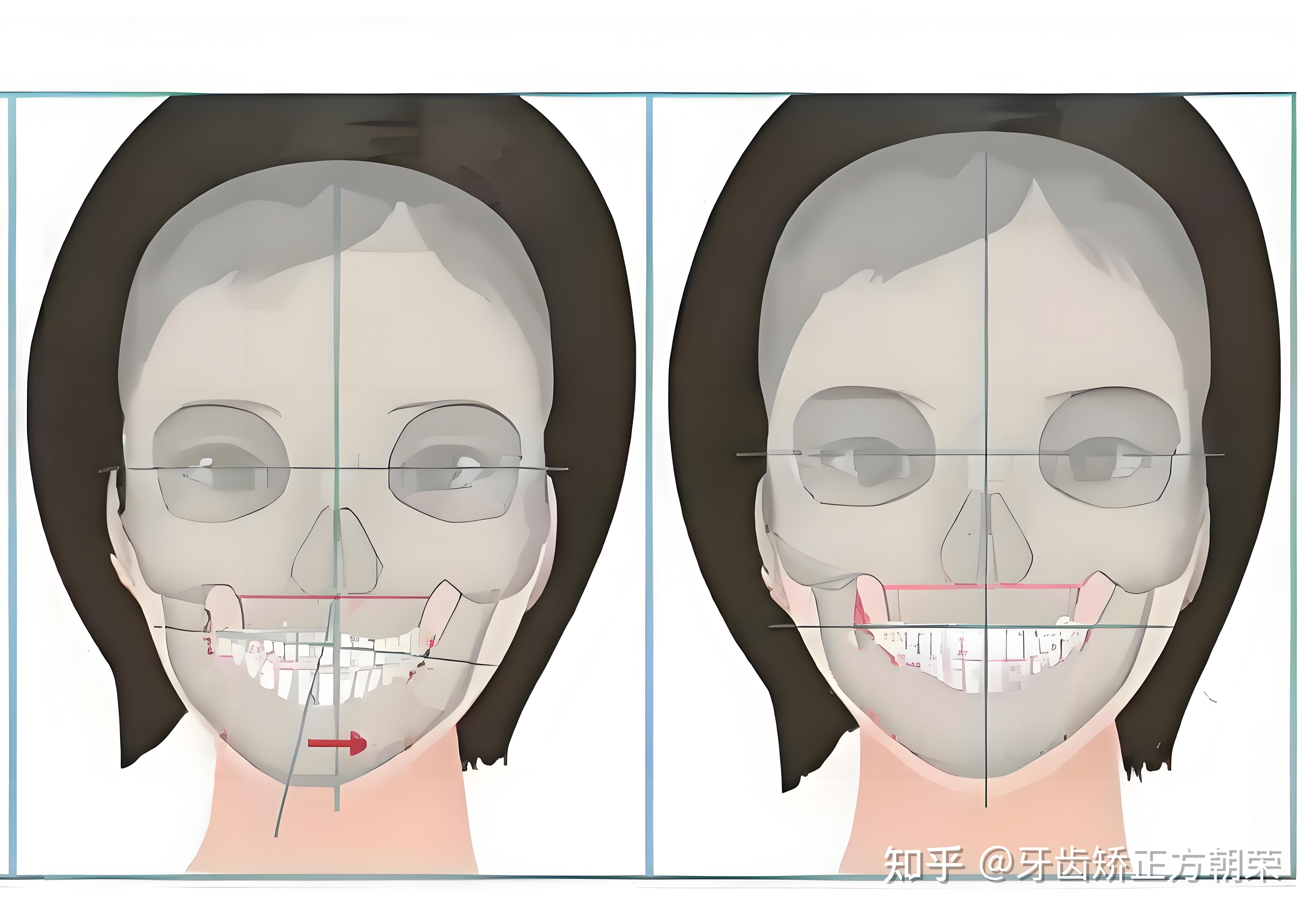 颞下颌关节紊乱左右脸不对称