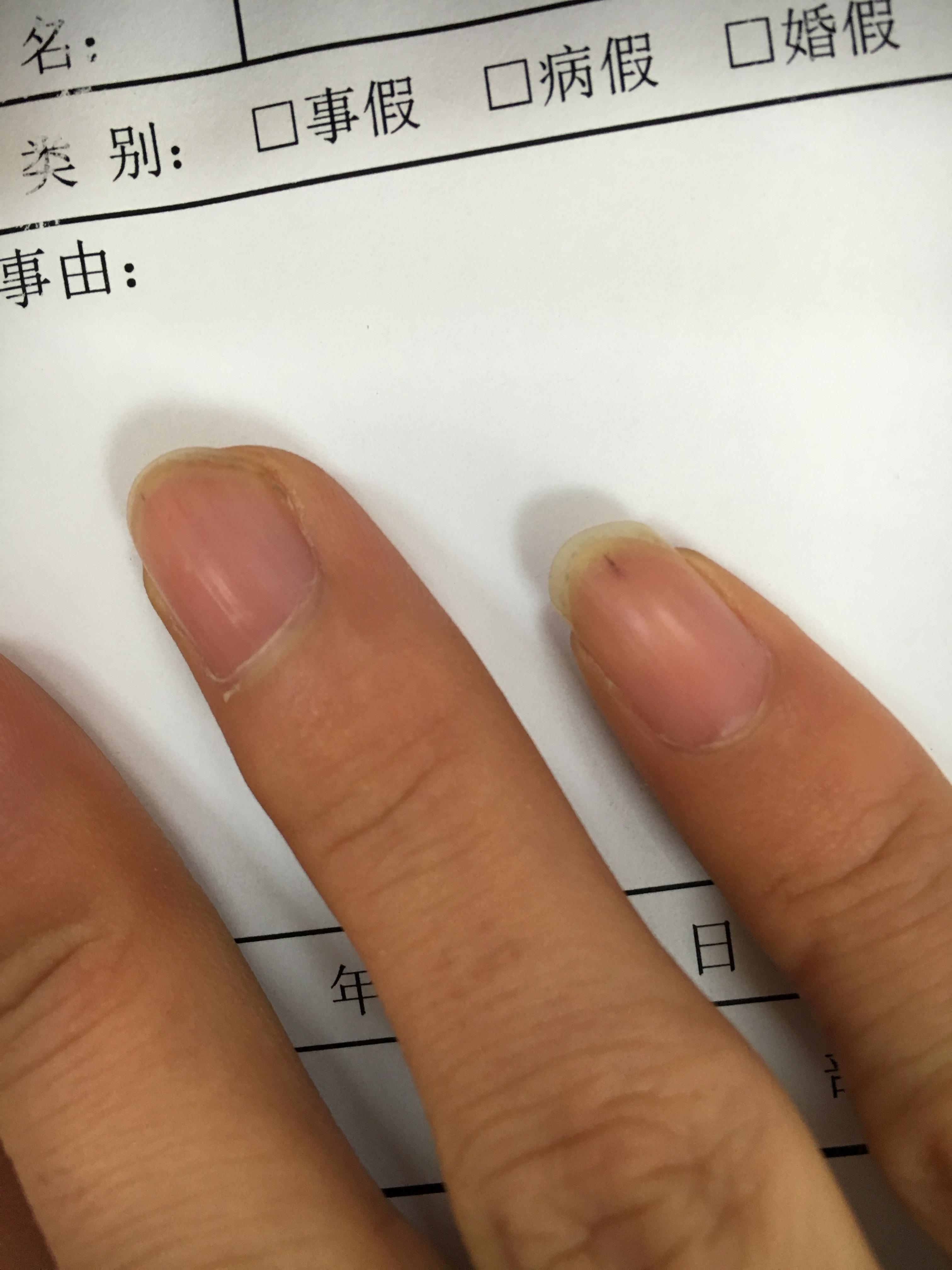 指甲上有一条淡淡黑线,怎么回事?两年了.