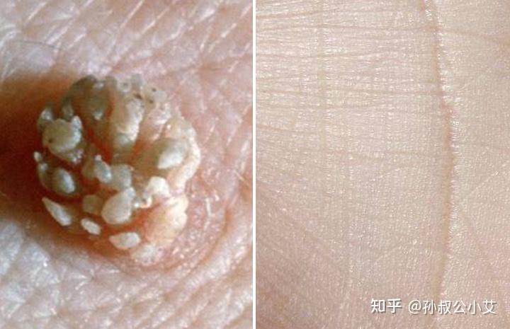 如何判断皮肤上出现的是疣? - 知乎