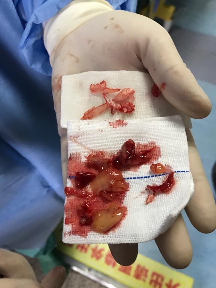 鼻息肉手术过程是怎么样的