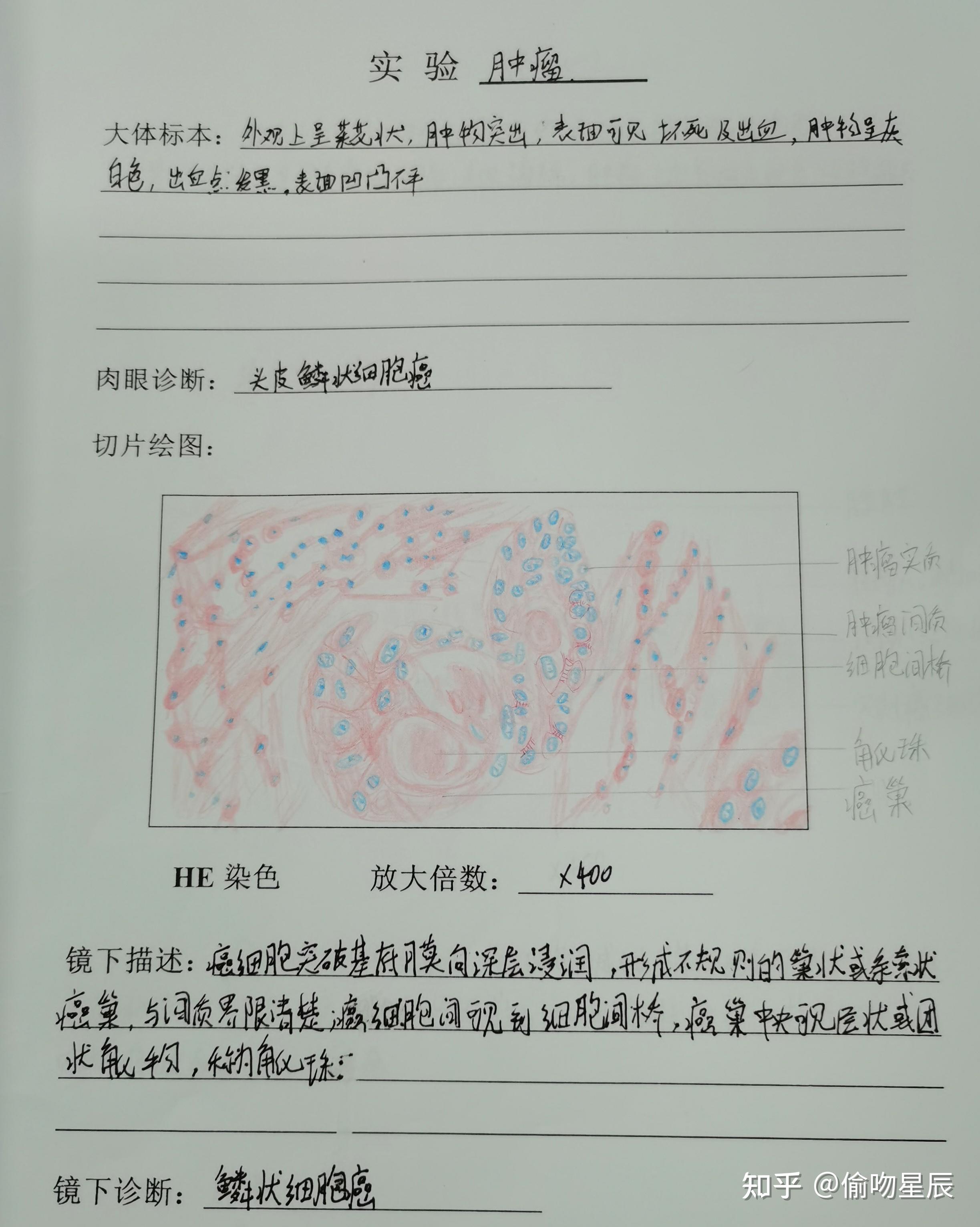 有没有人有病理的结肠腺癌红蓝铅笔手绘图啊? - 知乎