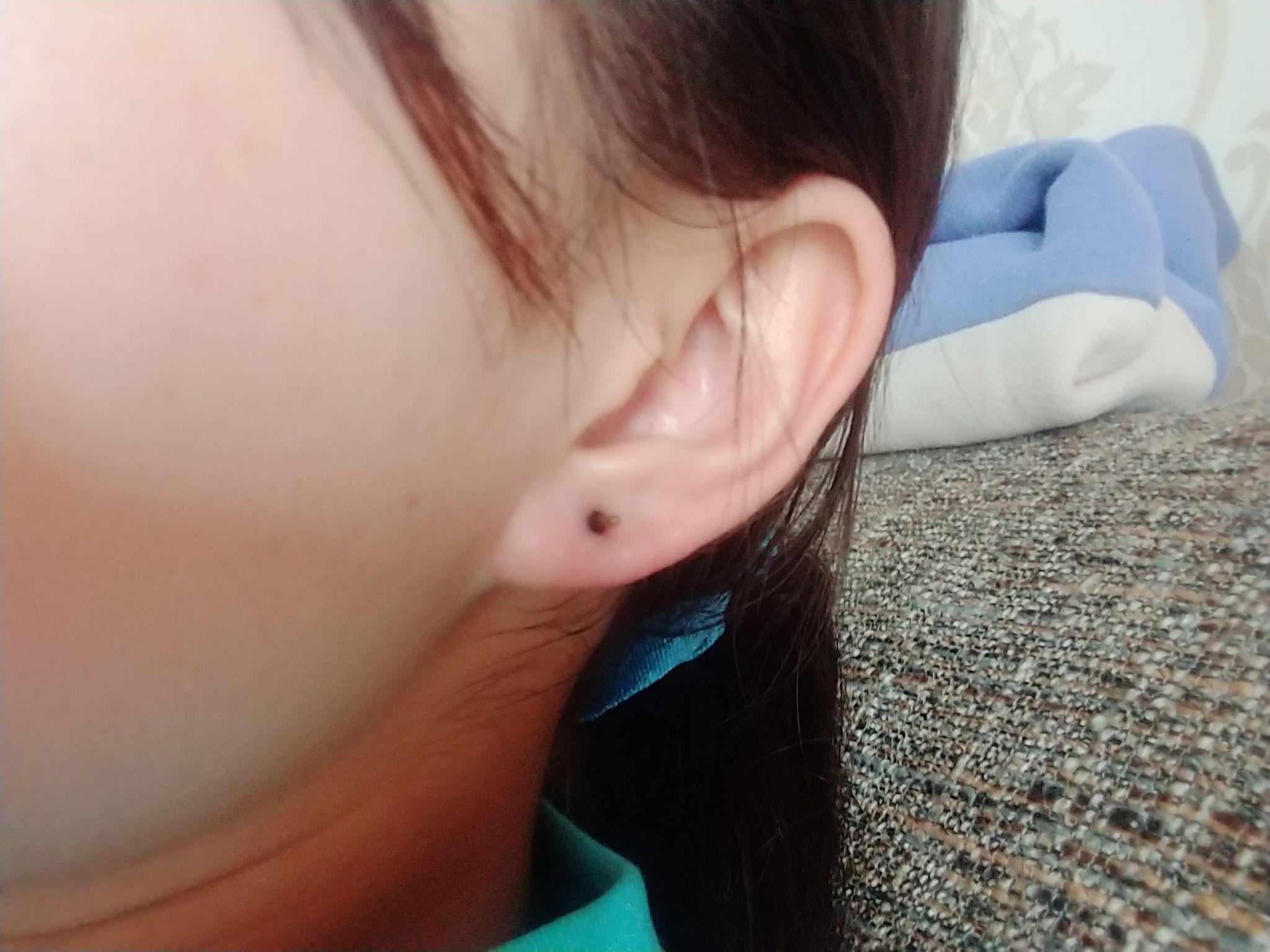 打耳洞后耳洞周围发黑怎么办? - 知乎