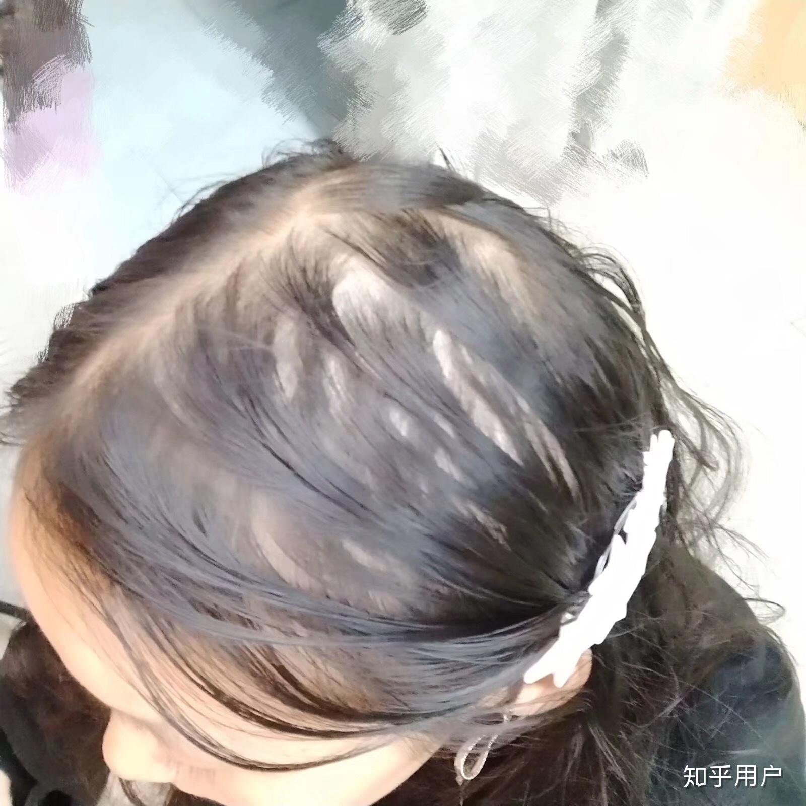 女生秃顶是怎样一种体验? - 知乎