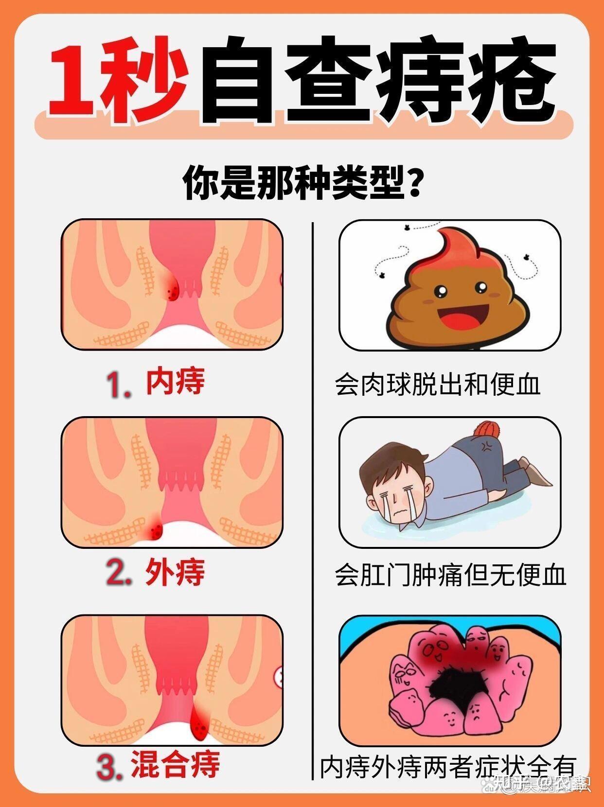 怀疑自己得了肛周脓肿,现在非常担心,怎么办?