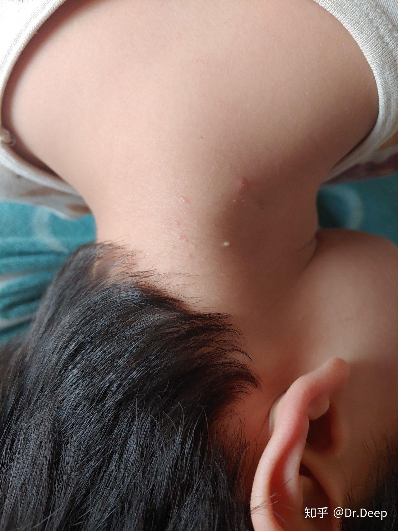 儿童疣的早期症状图片图片