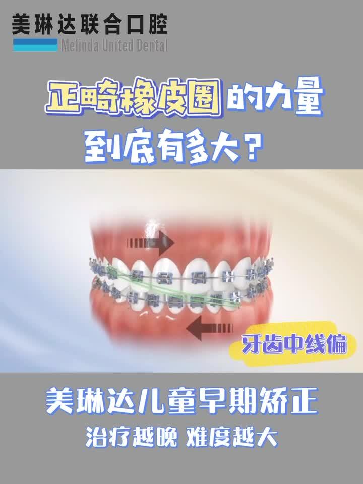 正畸三角牵引示意图图片