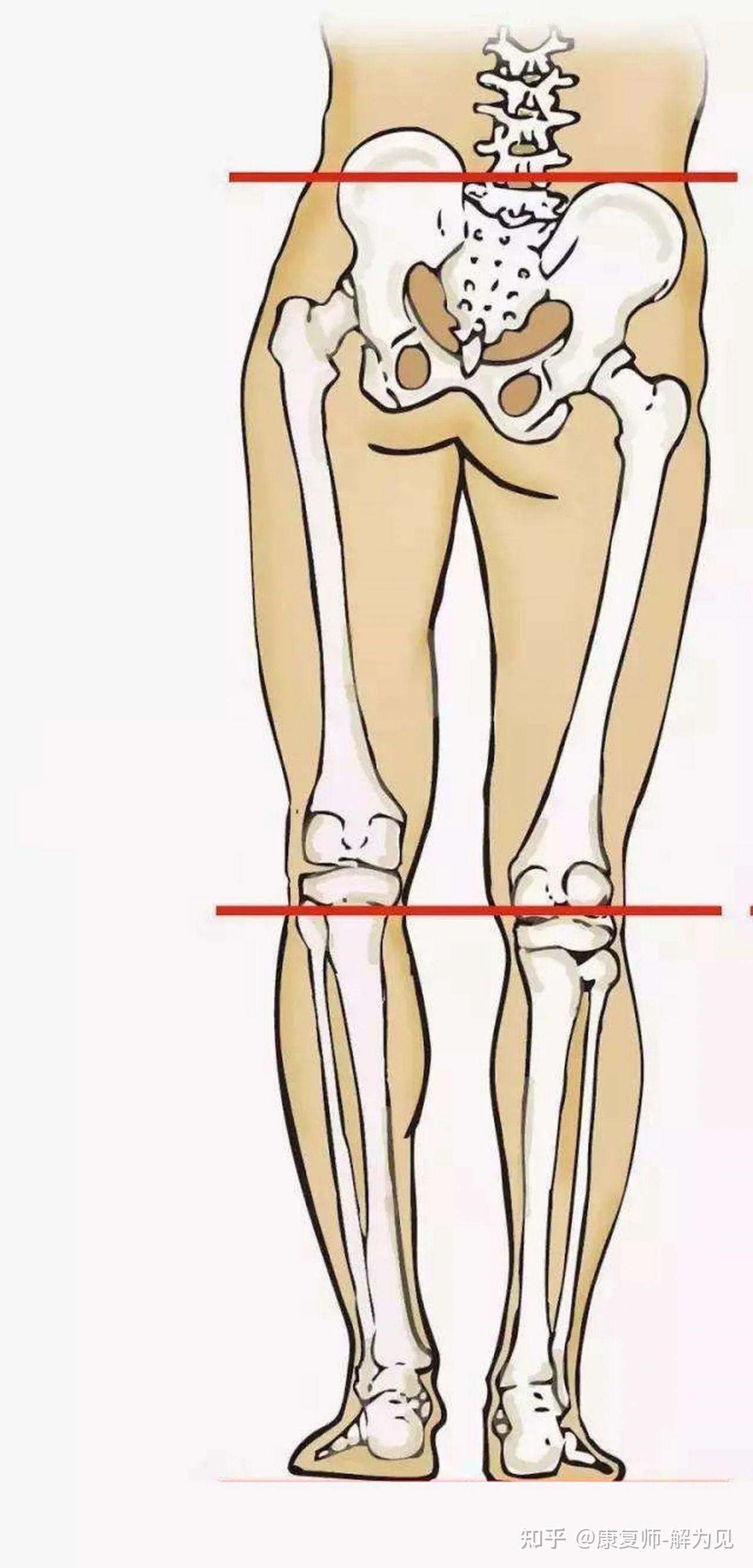 长短腿怎么矫正