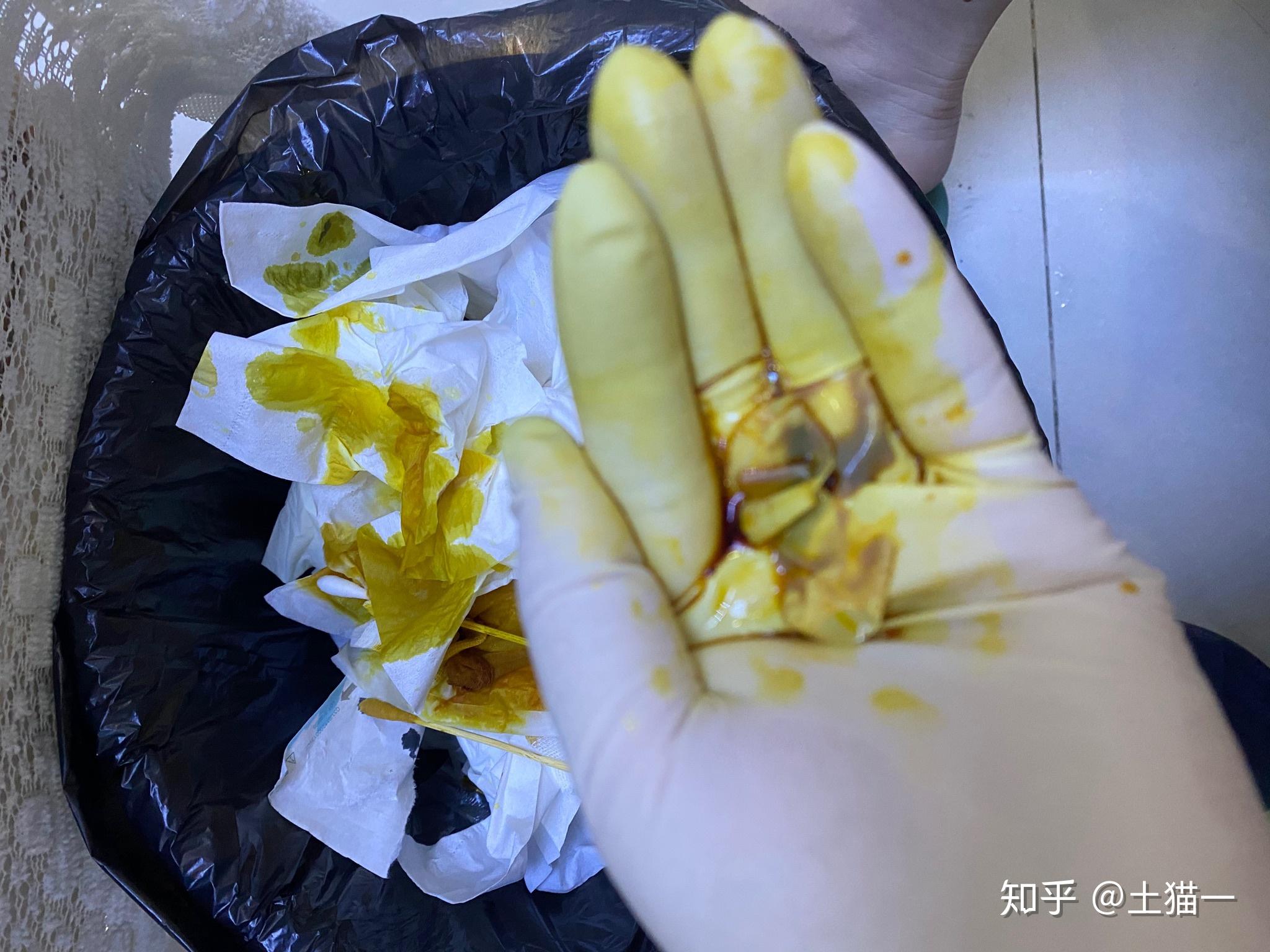 坐板疮怎么治疗呢已经好长时间了