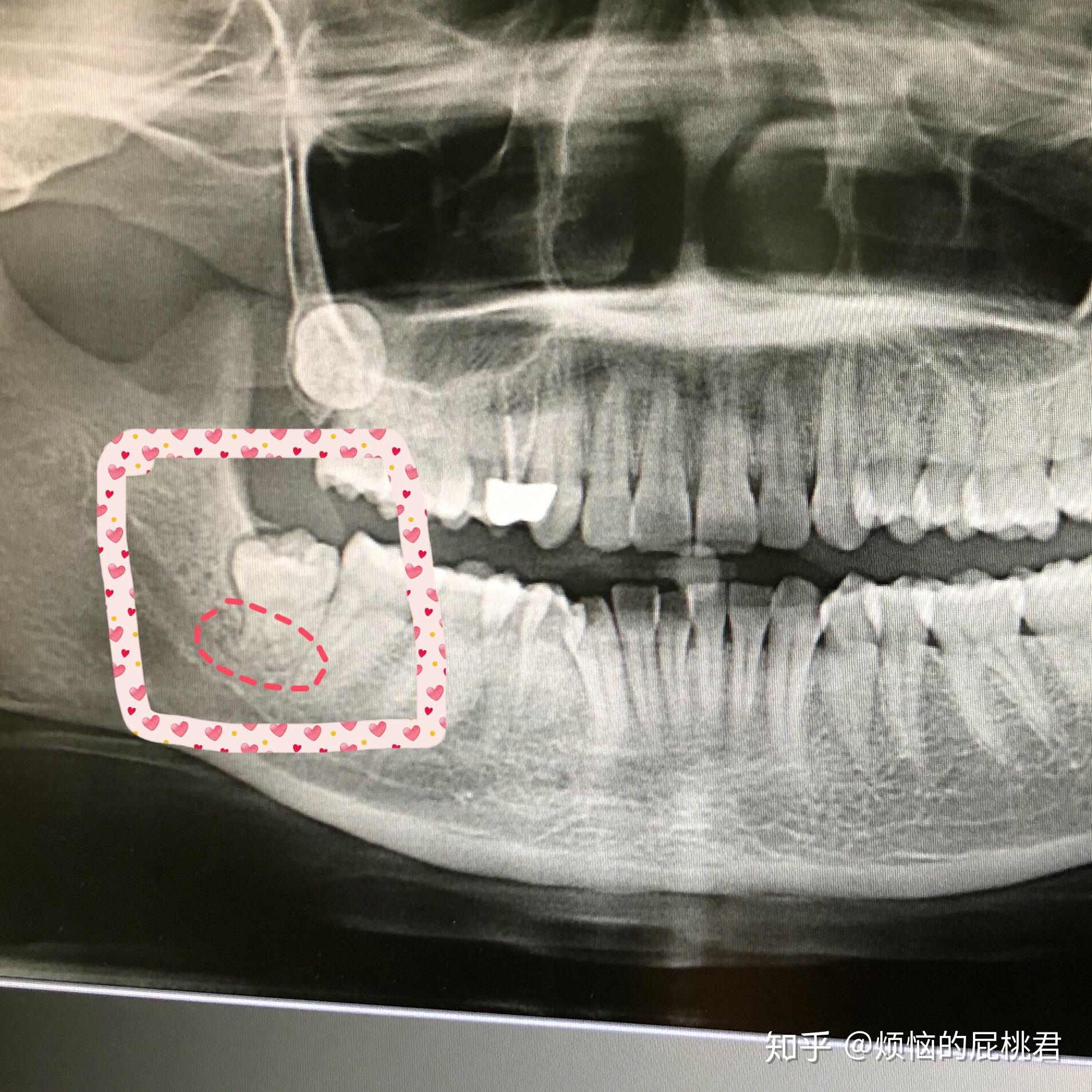 智齿牙根离牙神经近拔的话风险会不会很大
