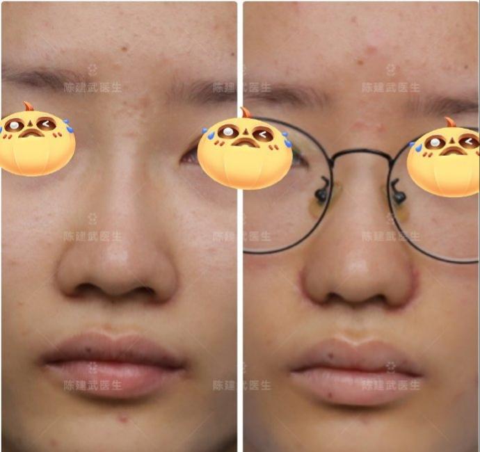 缩鼻翼后鼻孔更扁了看看这个案例