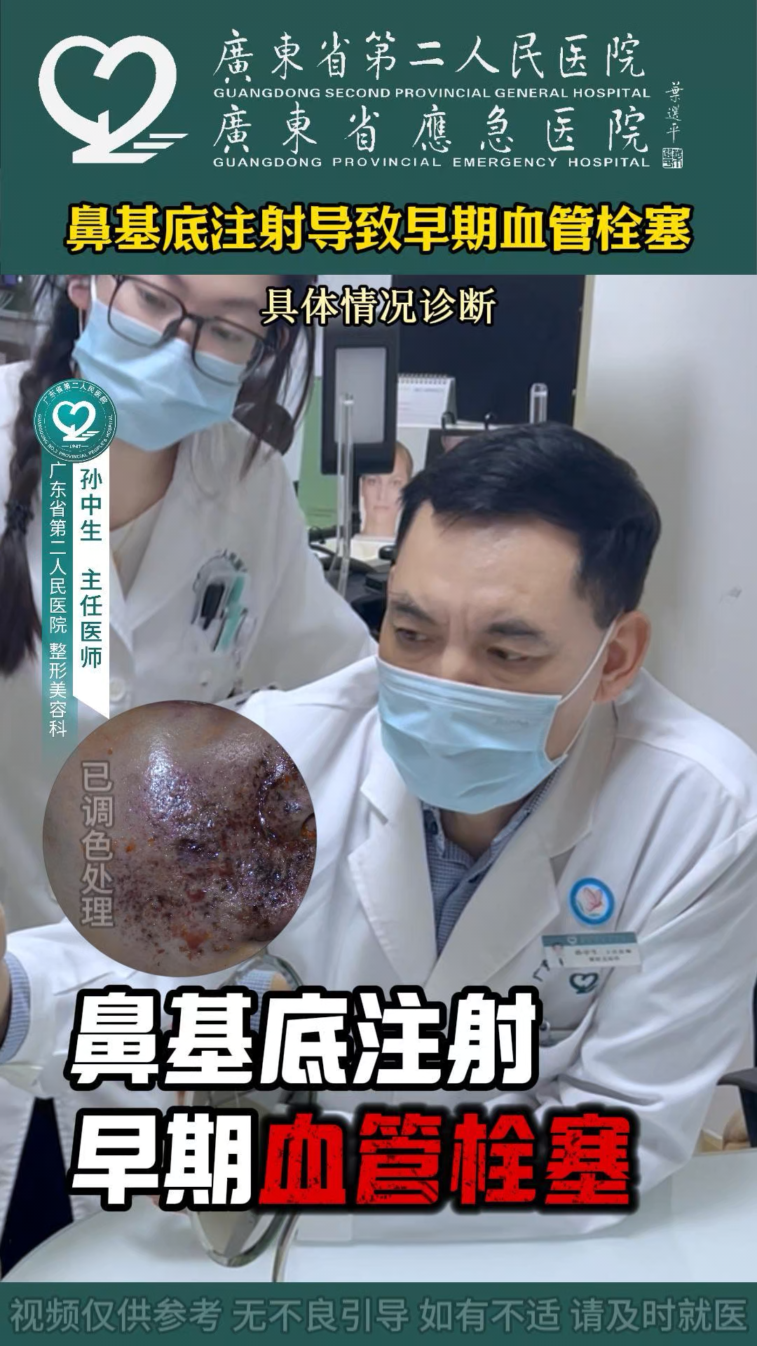 鼻基底注射导致早起血管栓塞