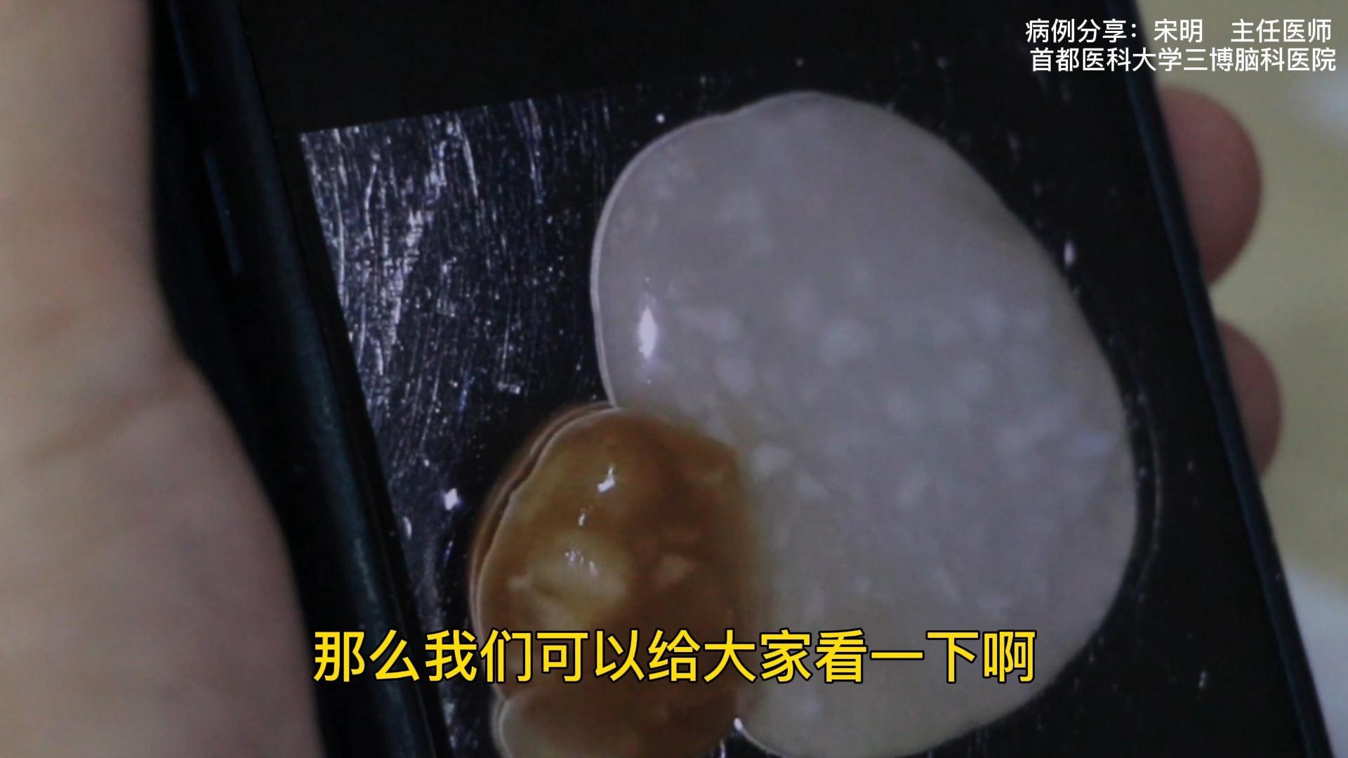 脑囊虫病常见的症状有哪些?