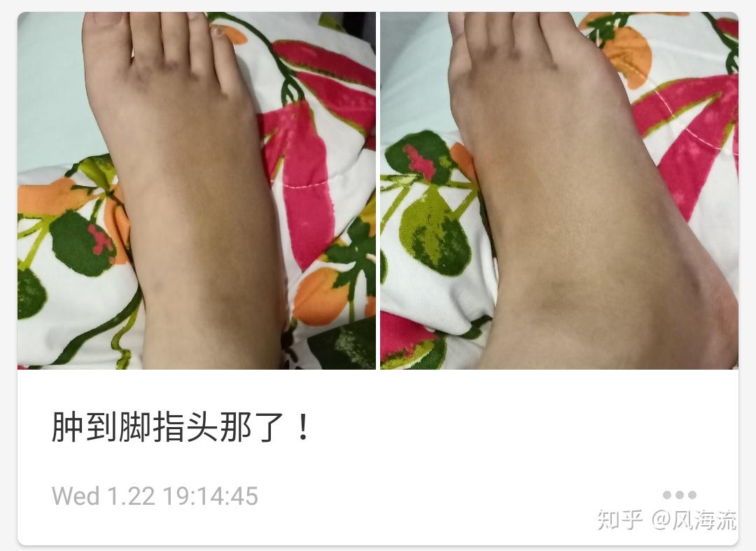 扭傷後腳背有腫塊請問怎麼消腫