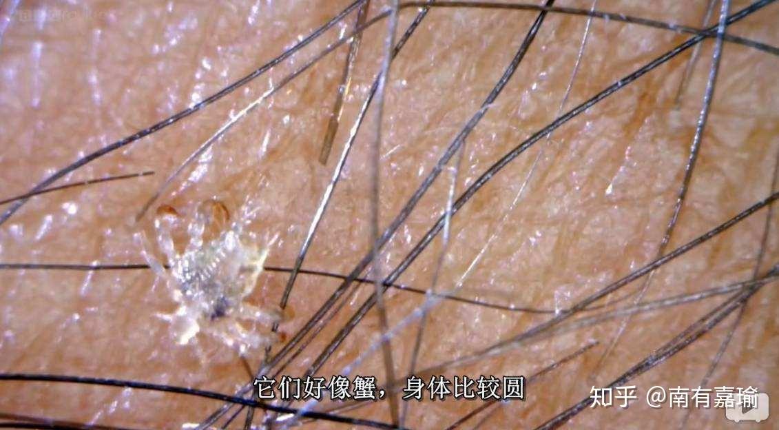 头发上找到的这是什么虫子? - 知乎