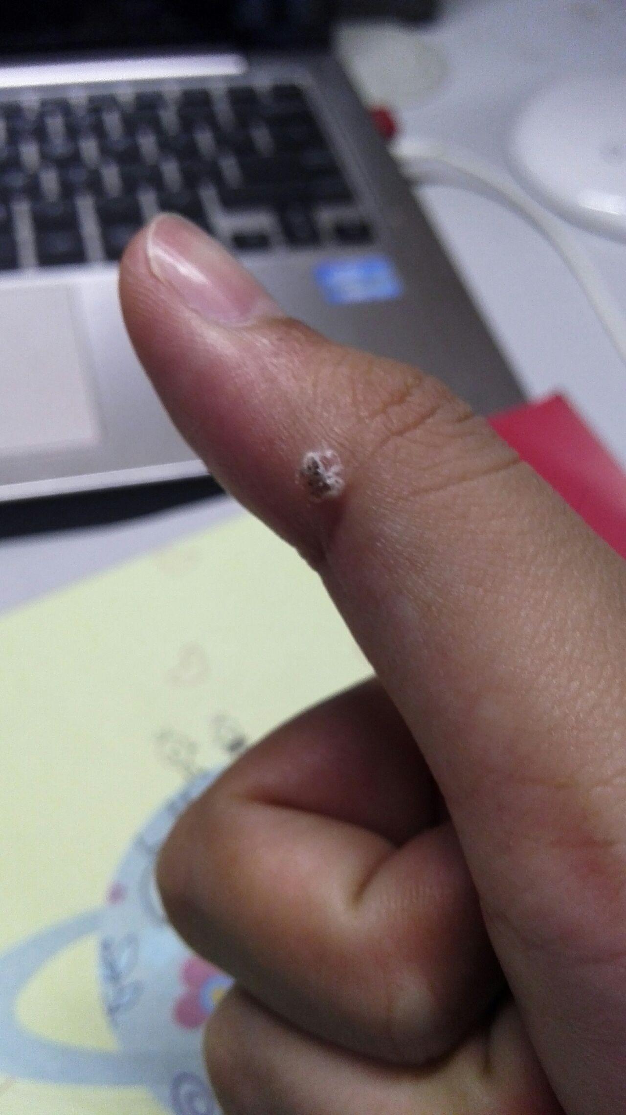 治疗手指上的寻常疣(鱼鳞痣)有什么办法,或者药物? - 知乎