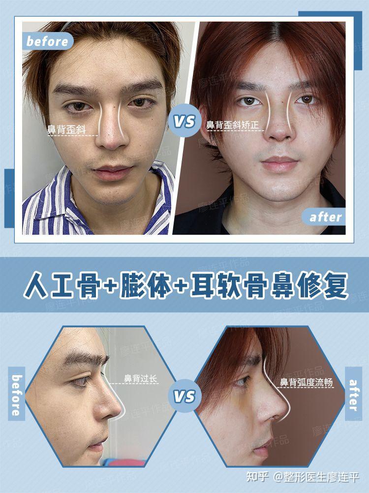 鼻子审美(十一)-鼻背的美学 - 知乎