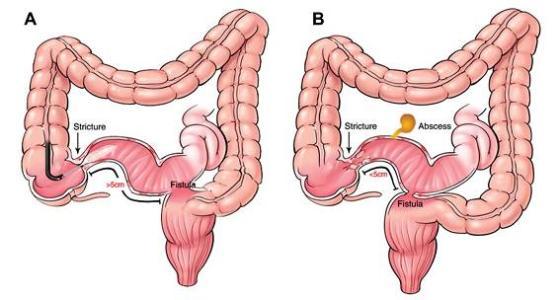 结肠瘘手术的注意事项有哪些