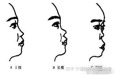 鞍鼻原来就是塌鼻梁?之前了解太少了 - 知乎