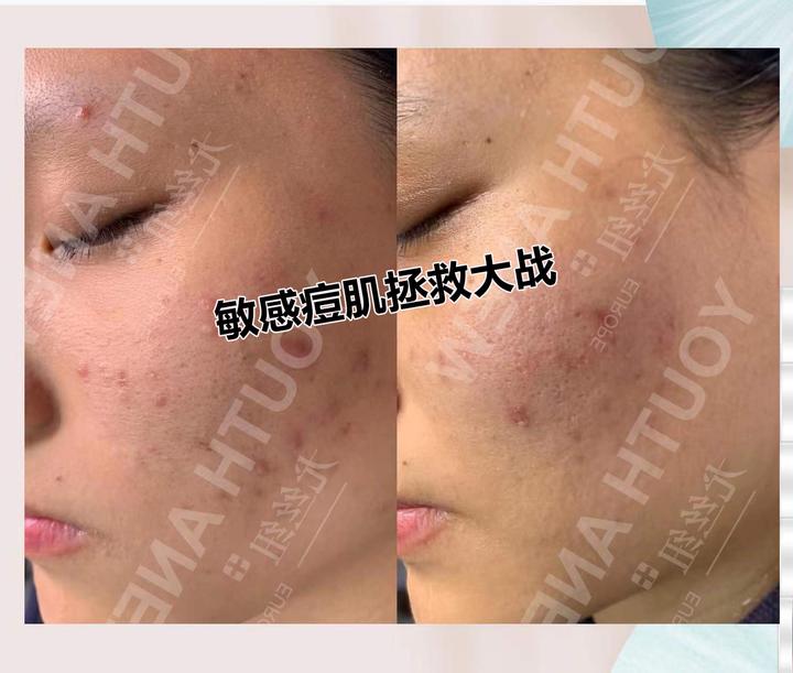 上帝到底给油敏皮开了哪扇窗？—又油又敏感肌肤这样做 - 知乎