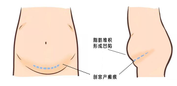 剖宫产术后疤痕产生的腹部凹陷怎么修复