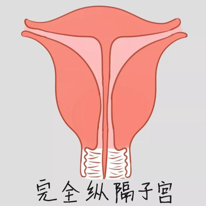 子宫纵隔会影响怀孕吗?