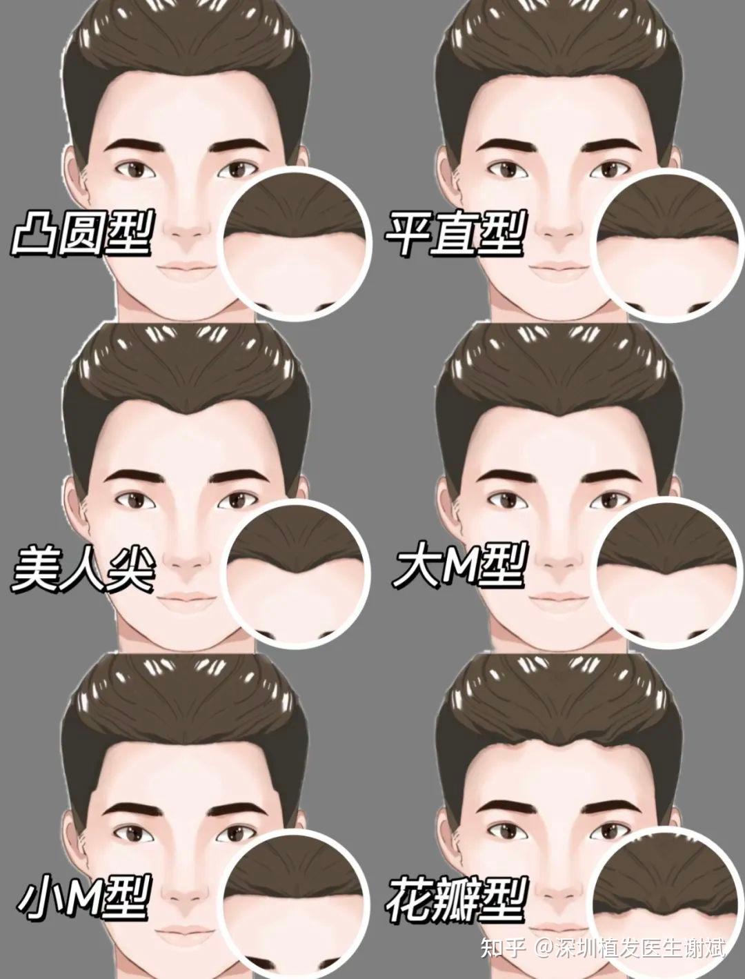 发际线植发,如何避免生硬不自然的发际线? - 知乎