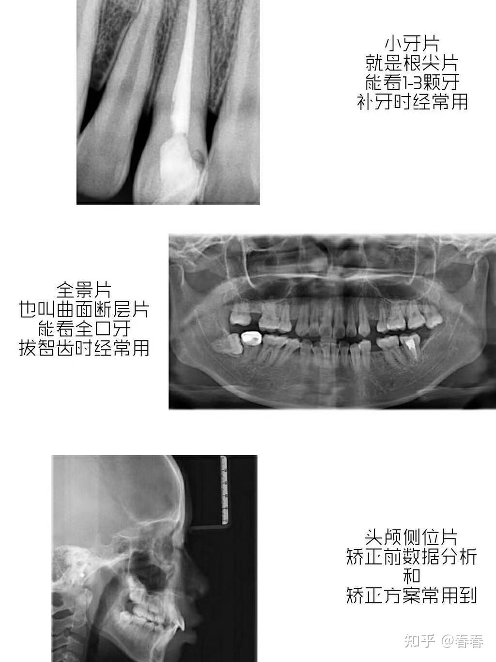 看牙拍各种 X 光片有什么用处? - 知乎