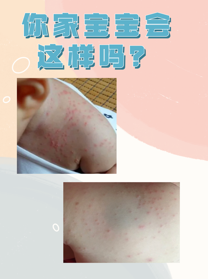 宝宝起疹全身痒?教你快速止痒消疹快! - 知乎