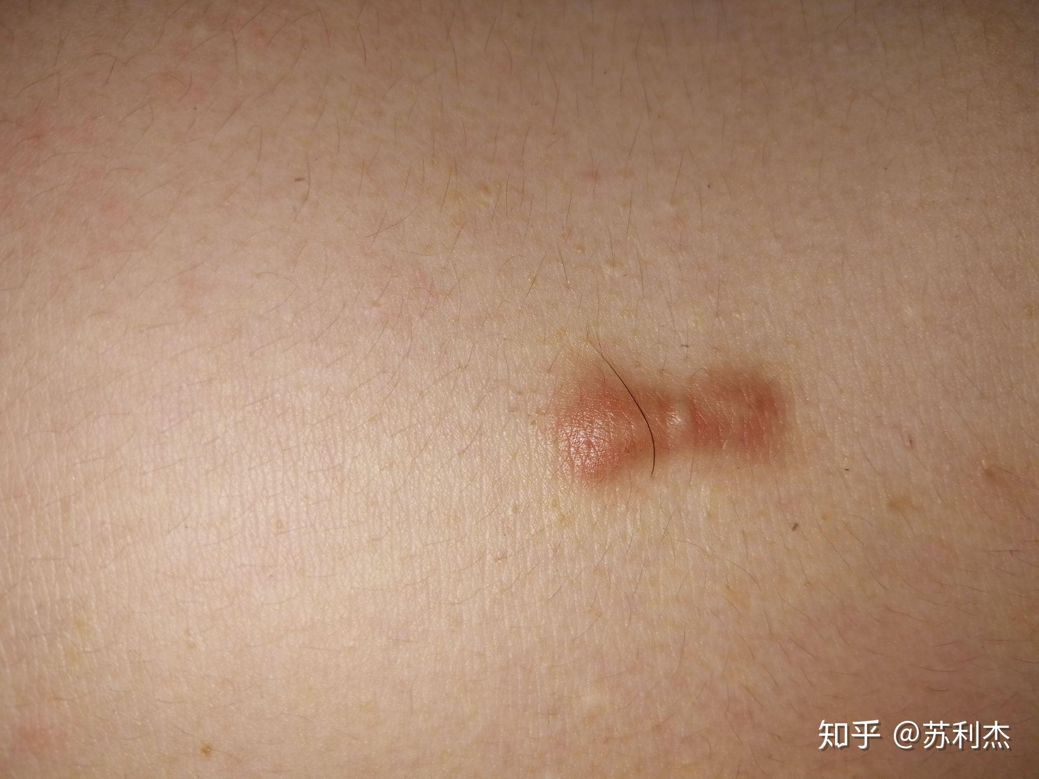 这是瘢痕疙瘩吗