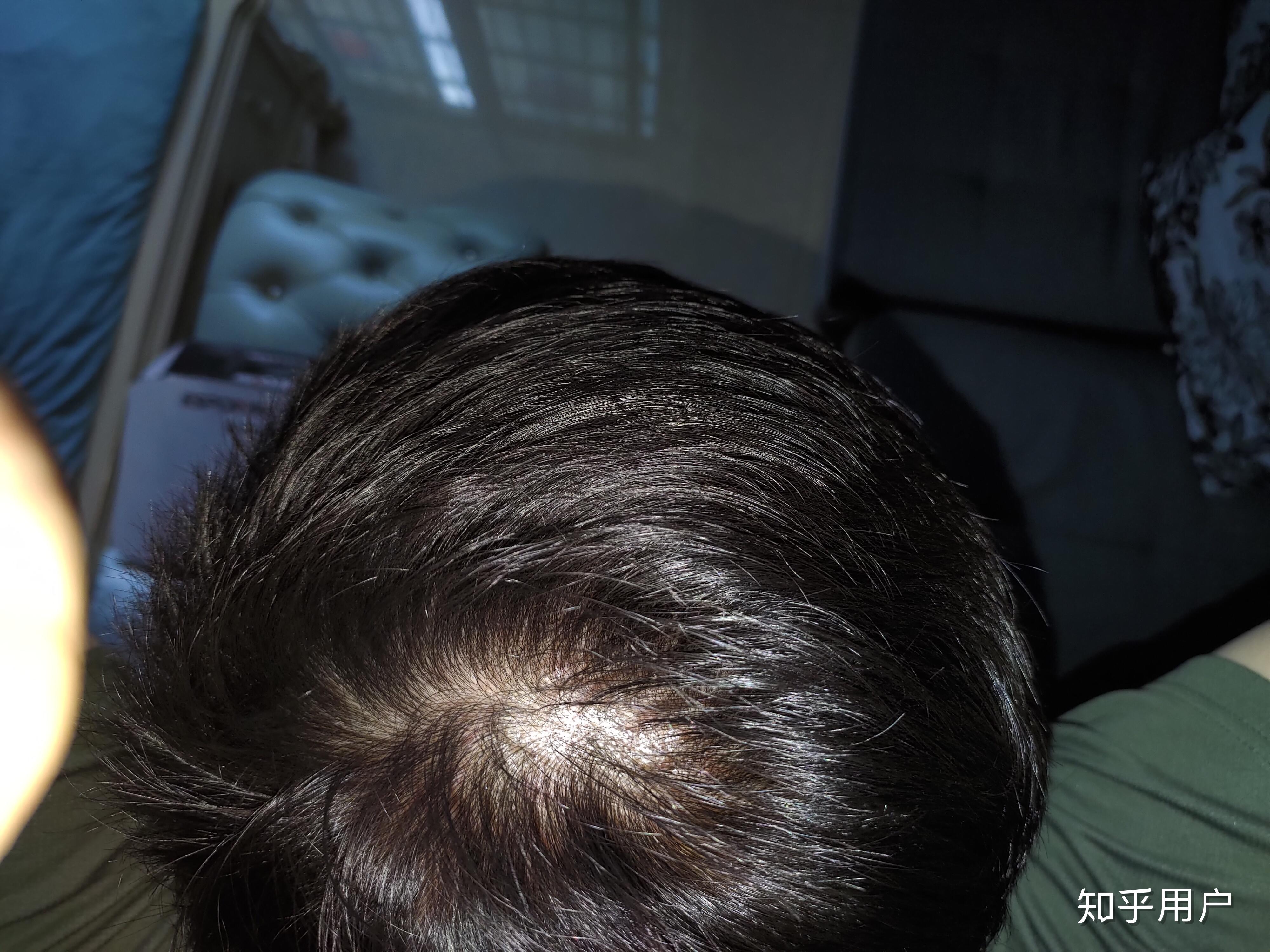 发旋附近头发少有图像这样正常吗
