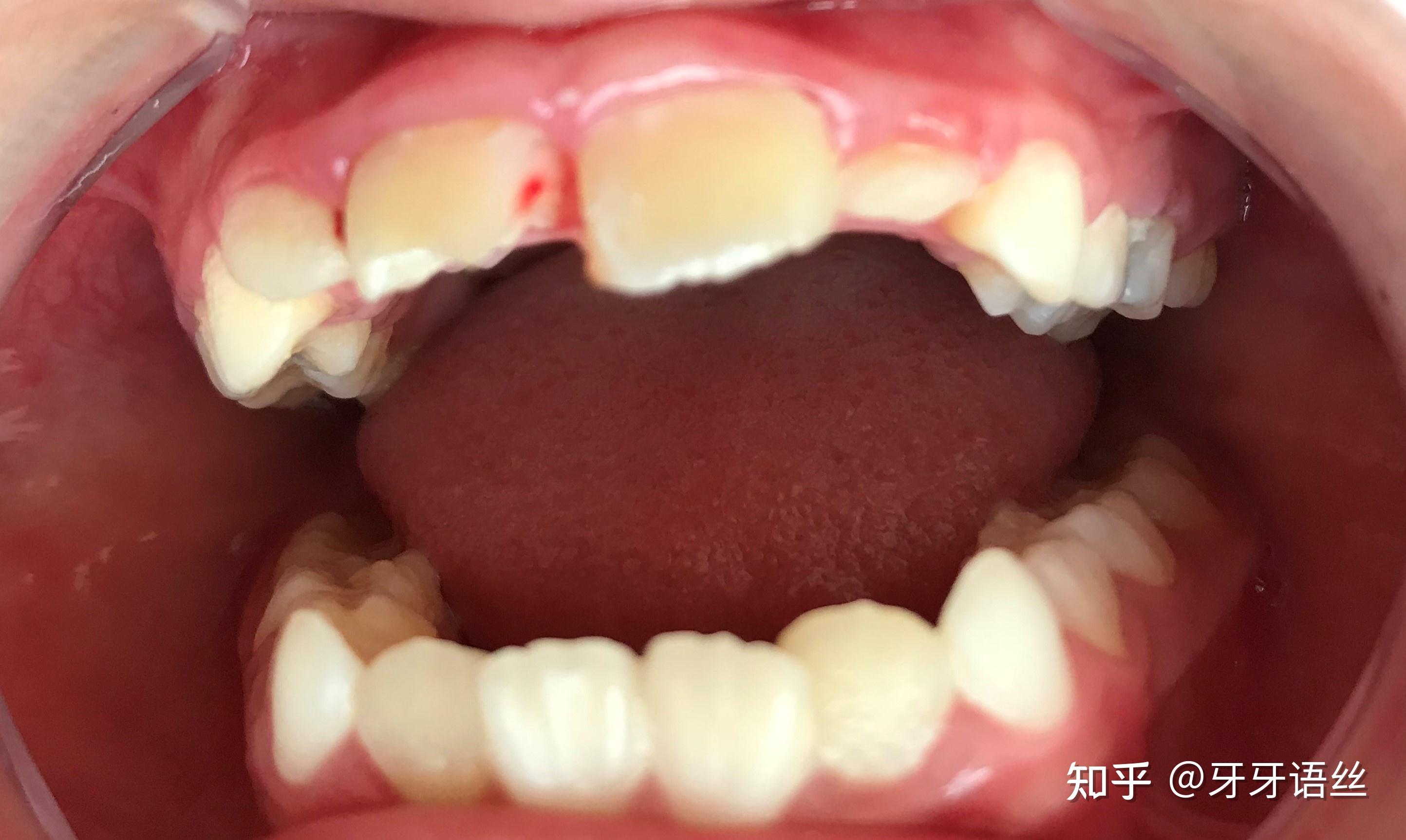 牙齿抽神经就“死”了吗？根管治疗3问答 | 蛀牙 | 牙套 | 牙冠 | 大纪元