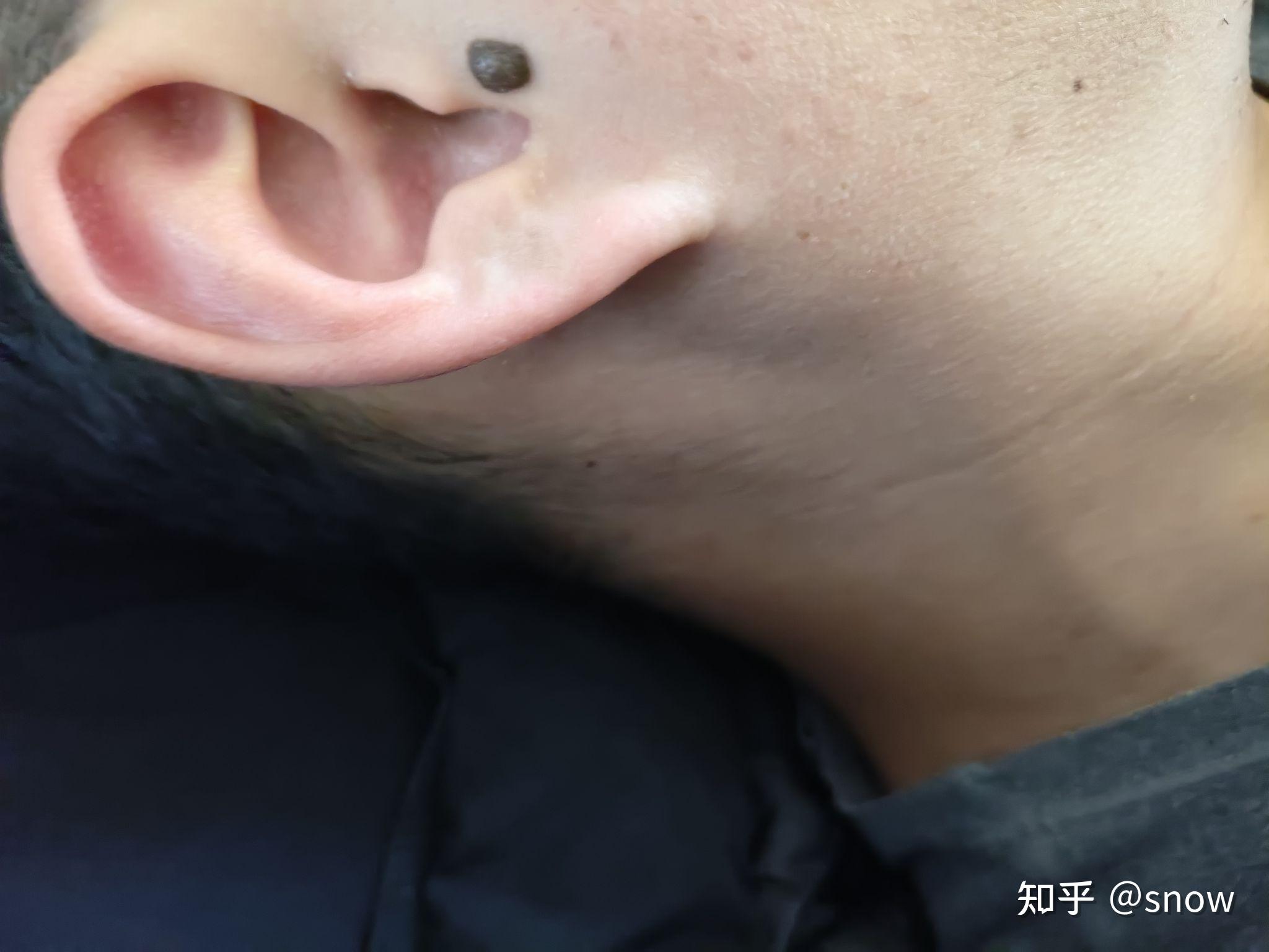 耳旁有一个很大的痣,你怎么看?