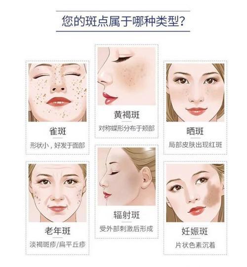 黄褐斑色斑雀斑晒斑辐射斑老年斑这么多斑都是怎么来的