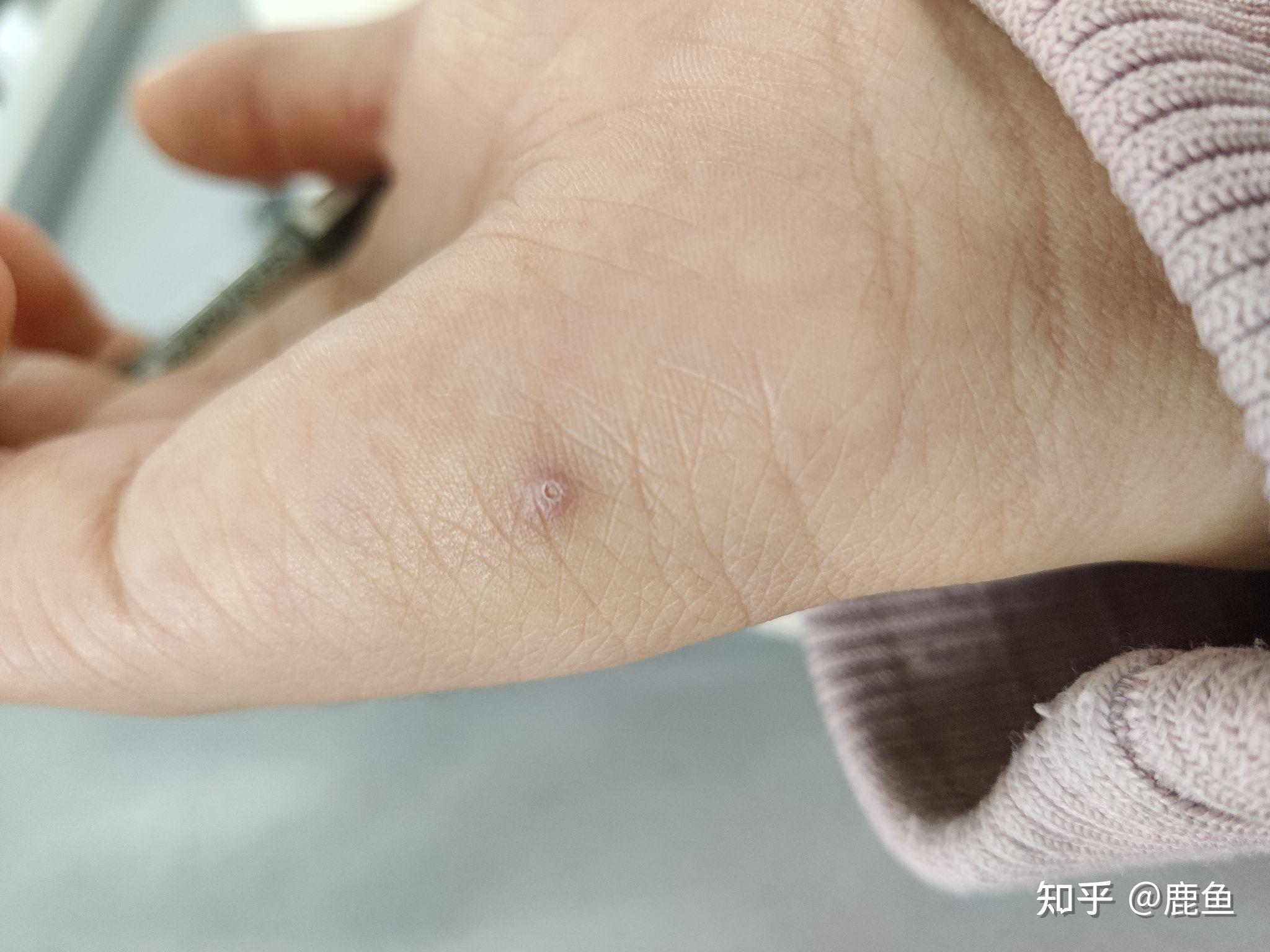 手扎刺如果不挑出来会有怎样的后果? - 知乎