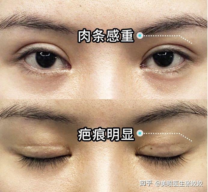 双眼皮的肉条感有好的方法可以消失吗?